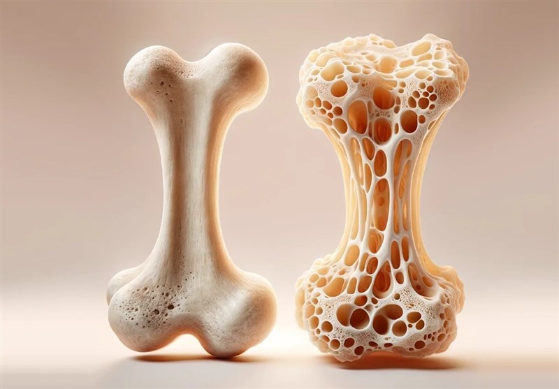 شیوع ۸۰درصدی مشکلات استخوانی در ایرانیان بالای ۵۰سال/ ۶۳درصد سالمندان کلسیم کافی مصرف نمیکنند