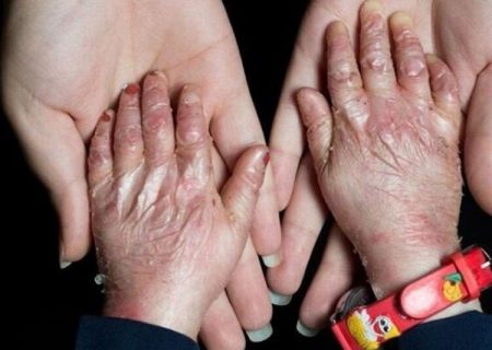 ۹۵ درصد بیماران «ای بی» حاصل ازدواج فامیلی/ امکان تشخیص پیش از تولد وجود ندارد