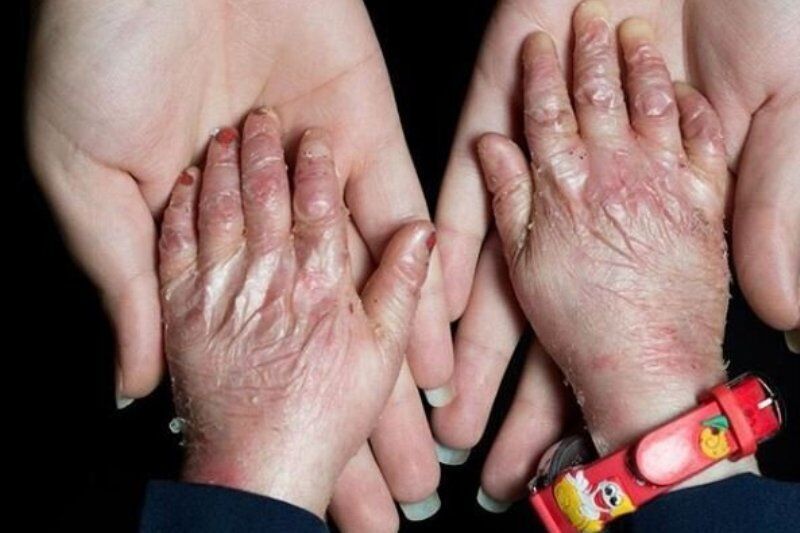 ۹۵ درصد بیماران «ای بی» حاصل ازدواج فامیلی/ امکان تشخیص پیش از تولد وجود ندارد